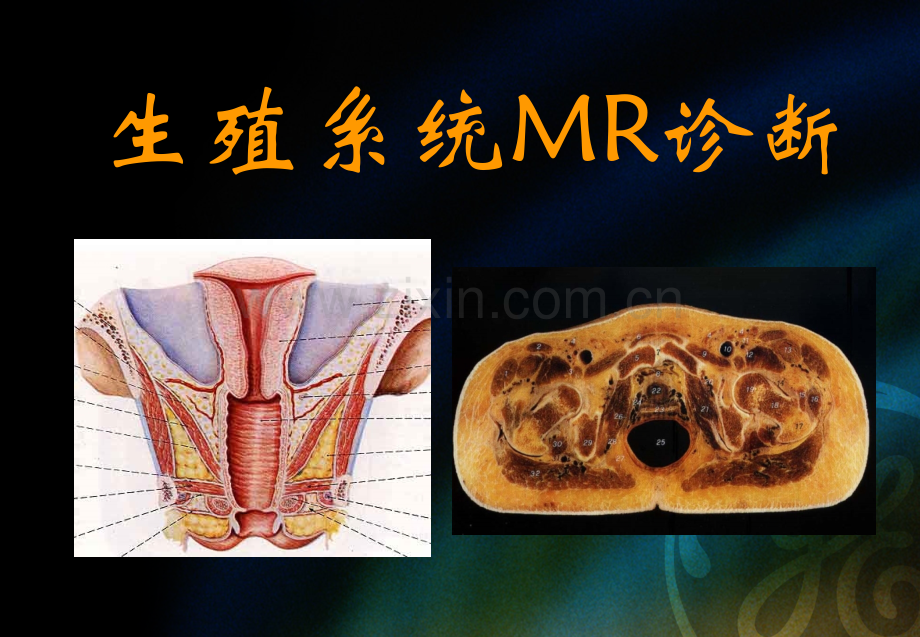 生殖系统MRI诊断.ppt_第1页