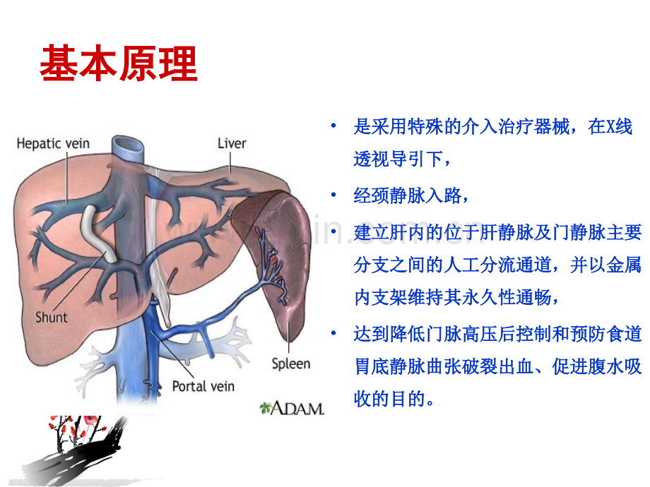 经颈静脉肝内门体静脉分流术.ppt_第3页