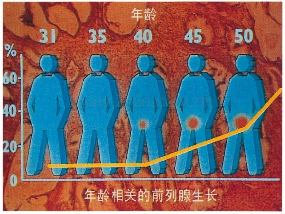 前列腺增生护理PPT.ppt_第3页