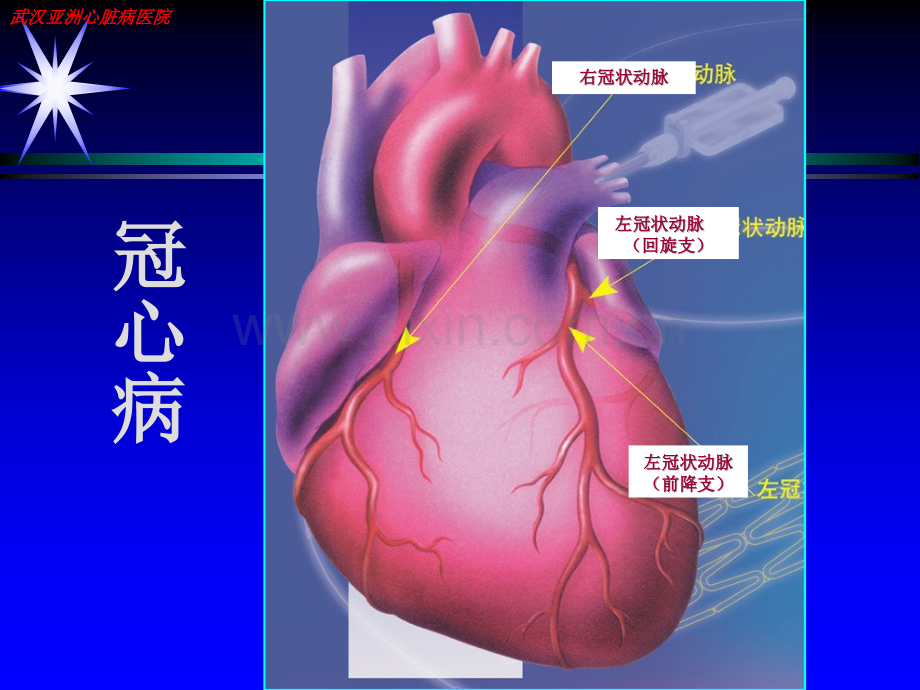 冠心病康复治疗及指导.pptx_第1页