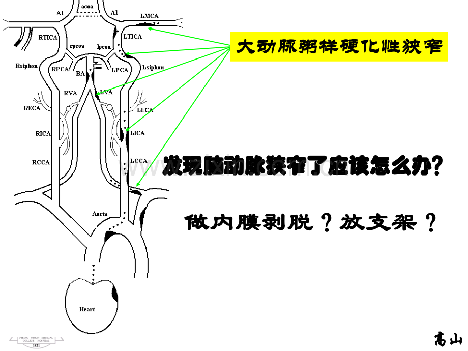 发现脑动脉狭窄了应该怎么办？-高+山.ppt_第2页