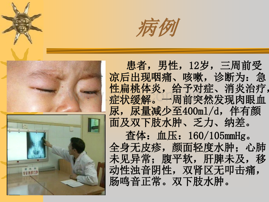 急性肾小球肾炎.ppt_第2页