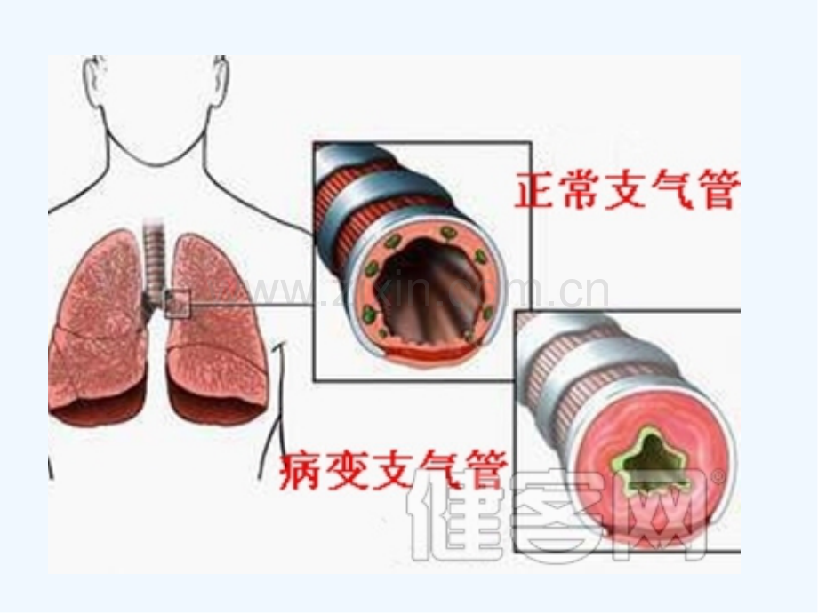 支气管扩张症护理查房ppt.pptx_第3页