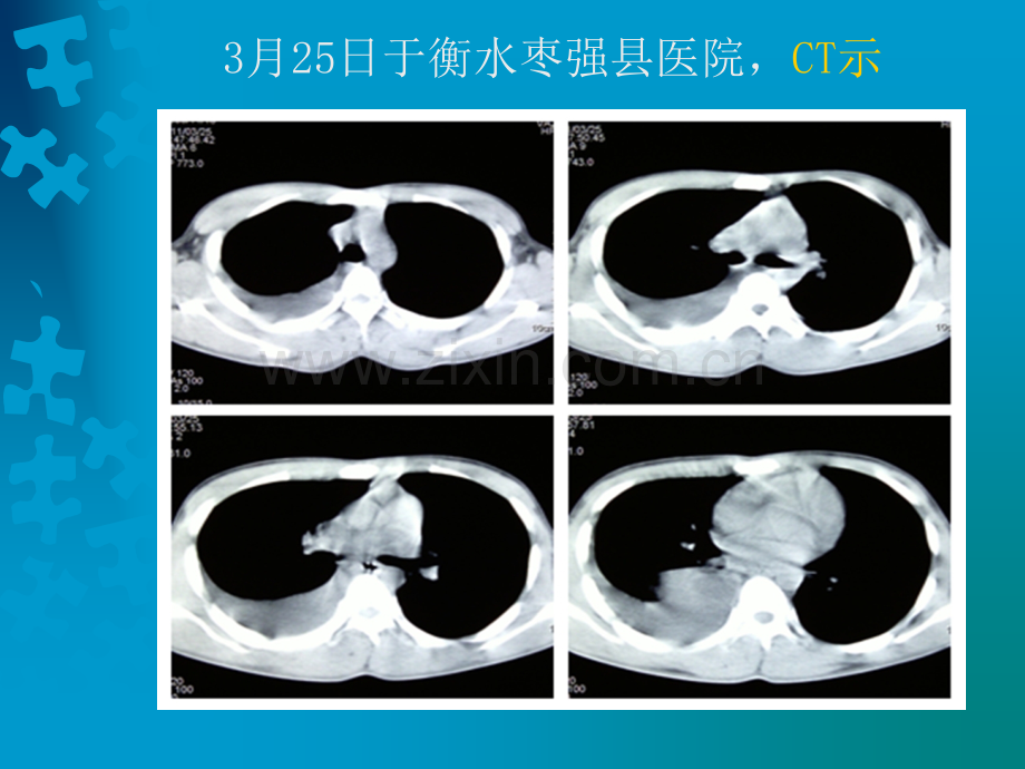 肠源性囊肿.ppt_第3页