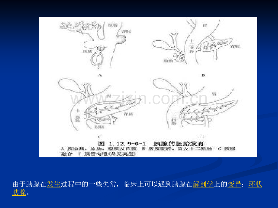 环状胰腺.ppt_第3页