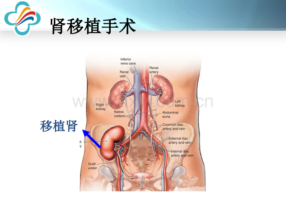 肾移植围手术管理.ppt_第3页