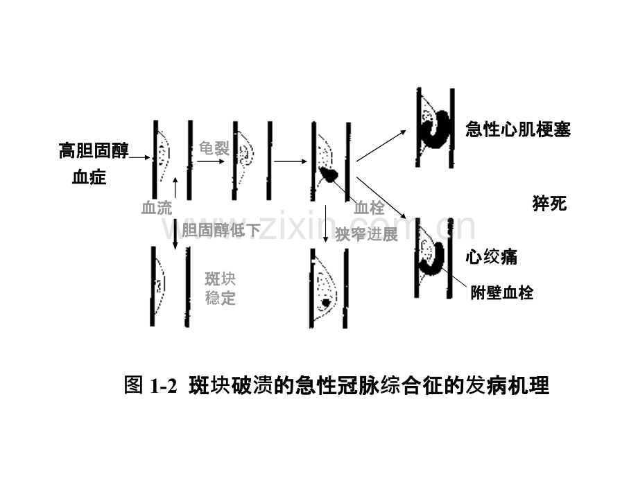 ami早期诊断与防治.pptx_第3页