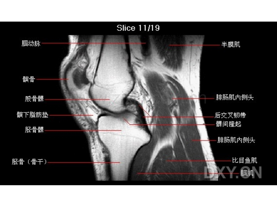 膝关节MRI.ppt_第1页