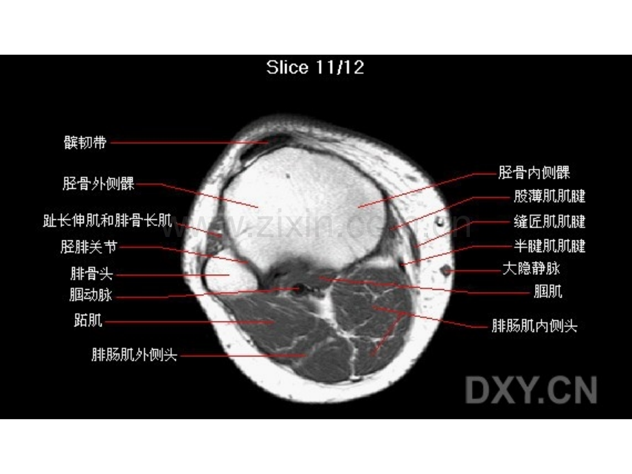 膝关节MRI.ppt_第2页