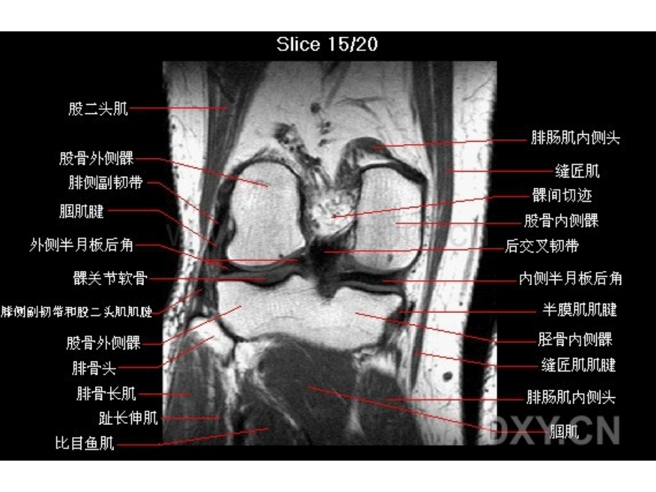 膝关节MRI.ppt_第3页