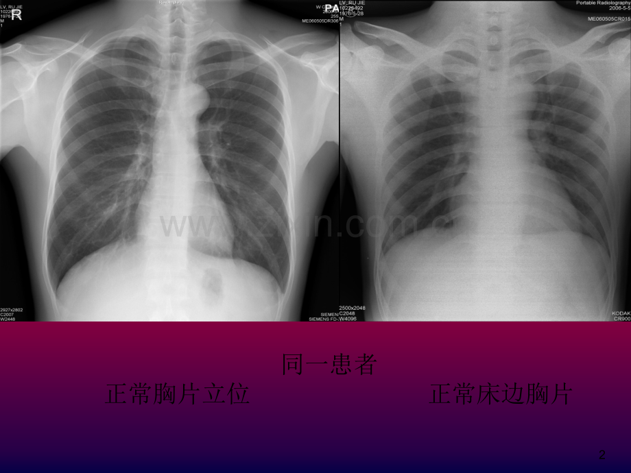 床边胸片分析-PPT.ppt_第2页