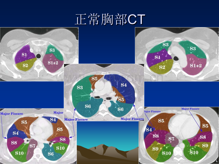 呼吸系统常见病典型胸部CT表现.ppt_第3页