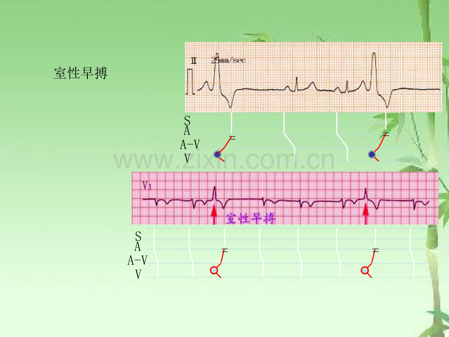 室性早搏的定位诊断与鉴别ppt.ppt_第3页