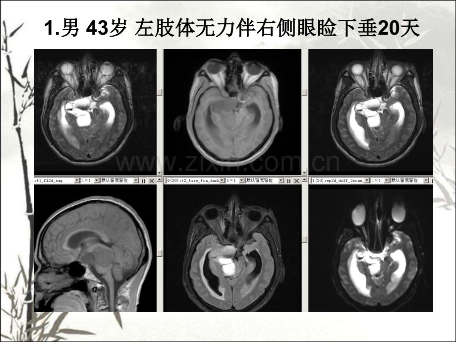 垂体瘤的MR诊断与鉴别诊断ppt.ppt_第2页