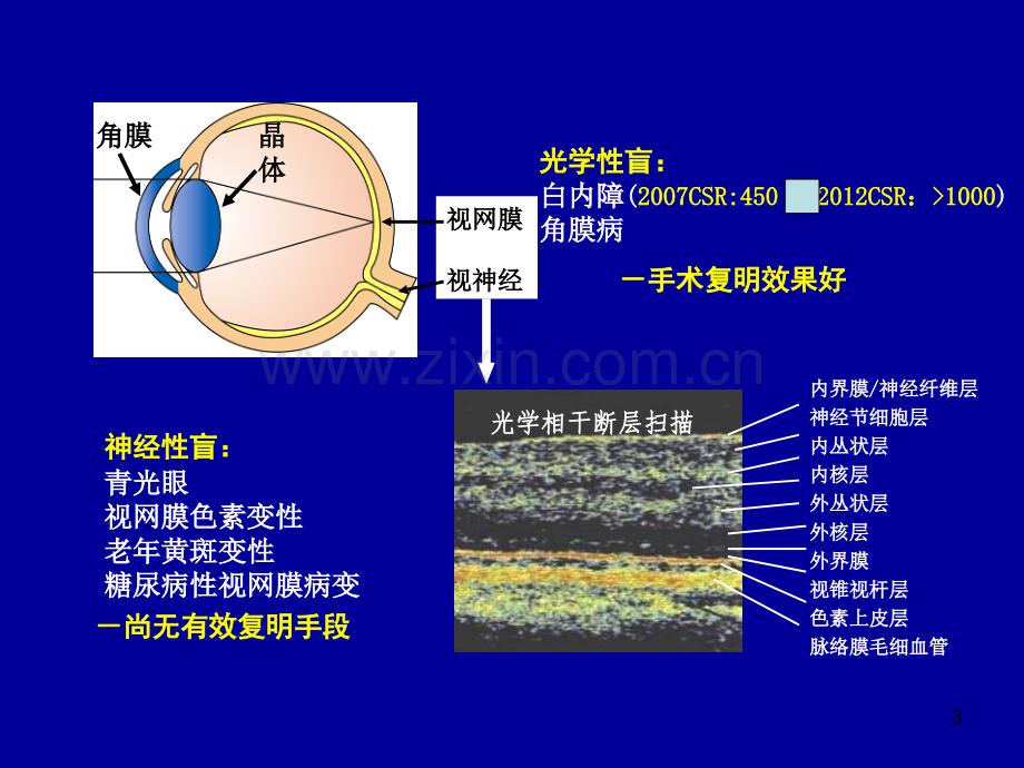 原发性开角型青光眼诊疗规范.ppt_第3页