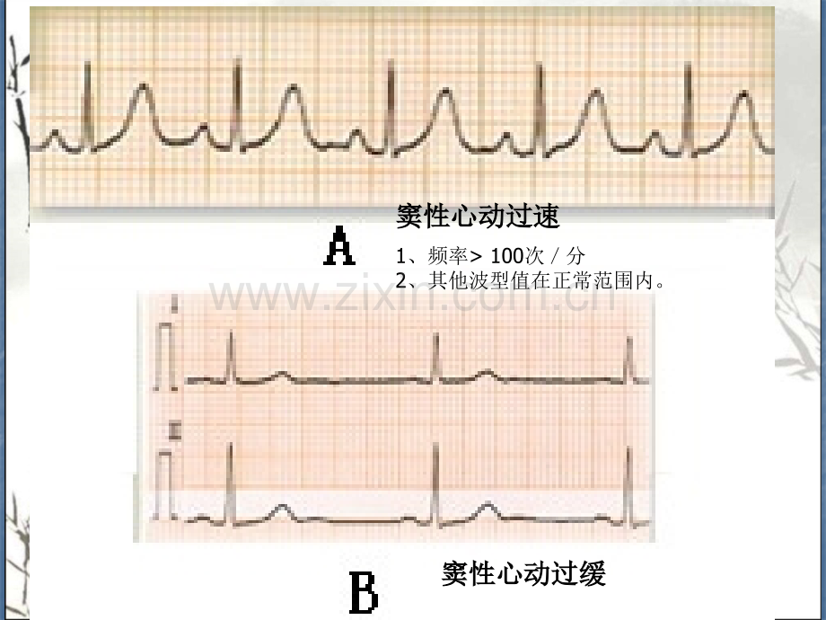 心内科常用心电图图谱读图ppt.ppt_第3页