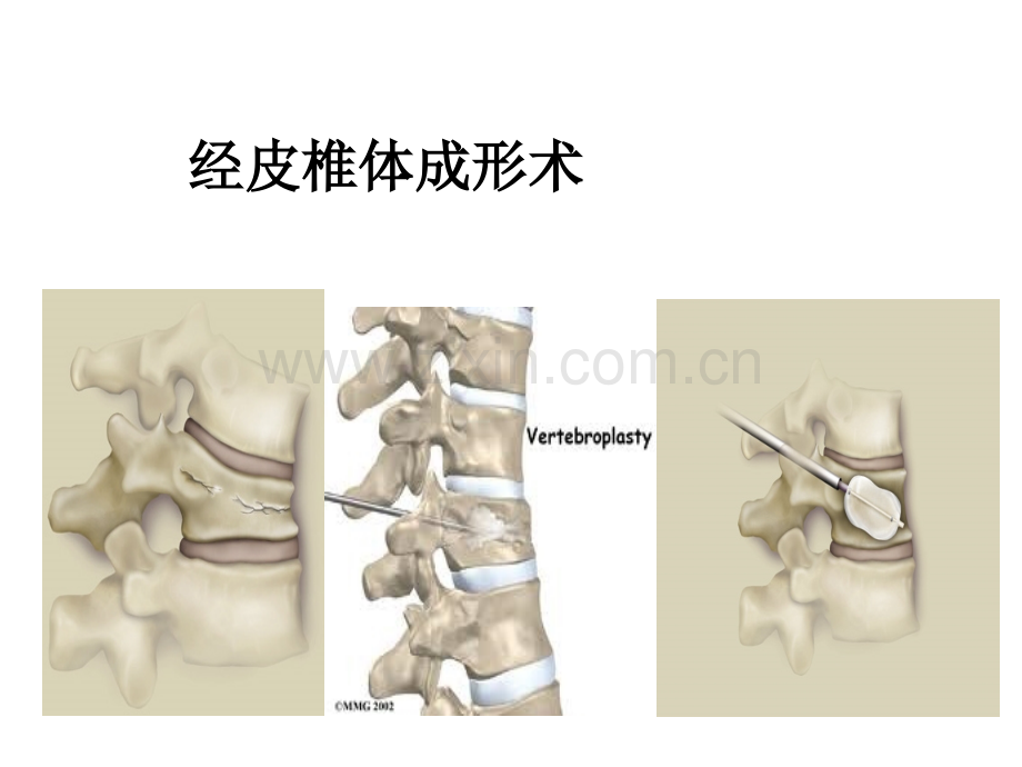 经皮椎体后凸成形术ppt.ppt_第1页