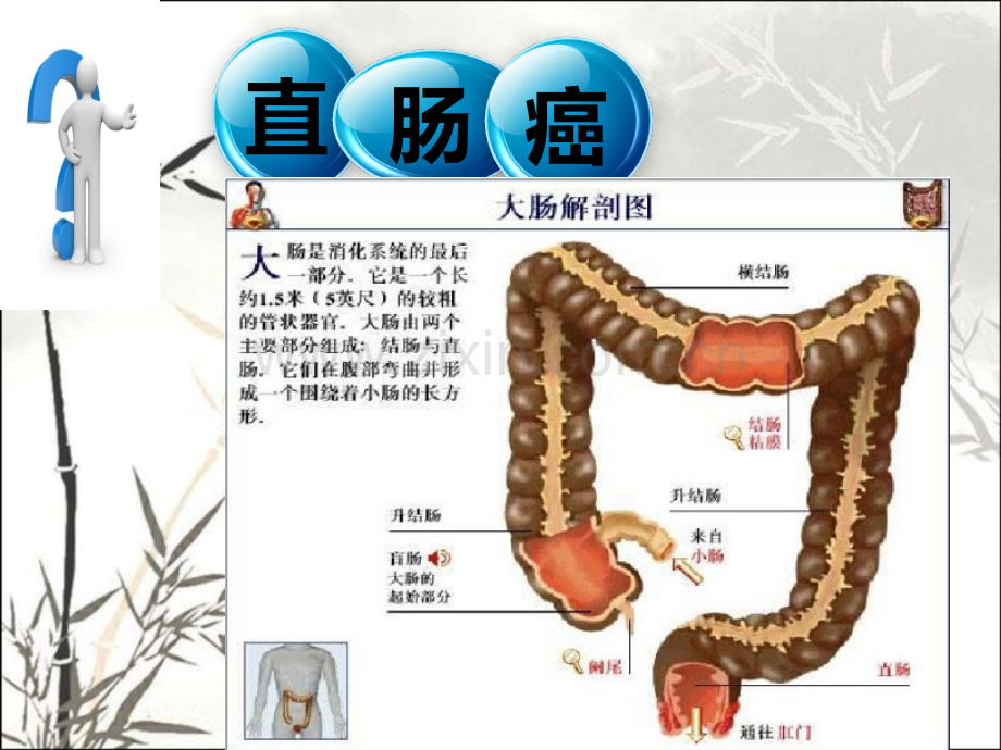 直肠癌的护理查房ppt.ppt_第3页