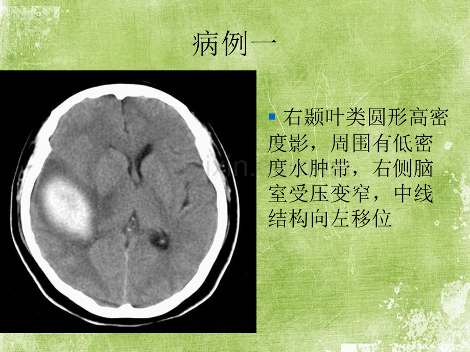 医学影像学病例讲解(MRI、CT、DR)ppt.ppt_第2页