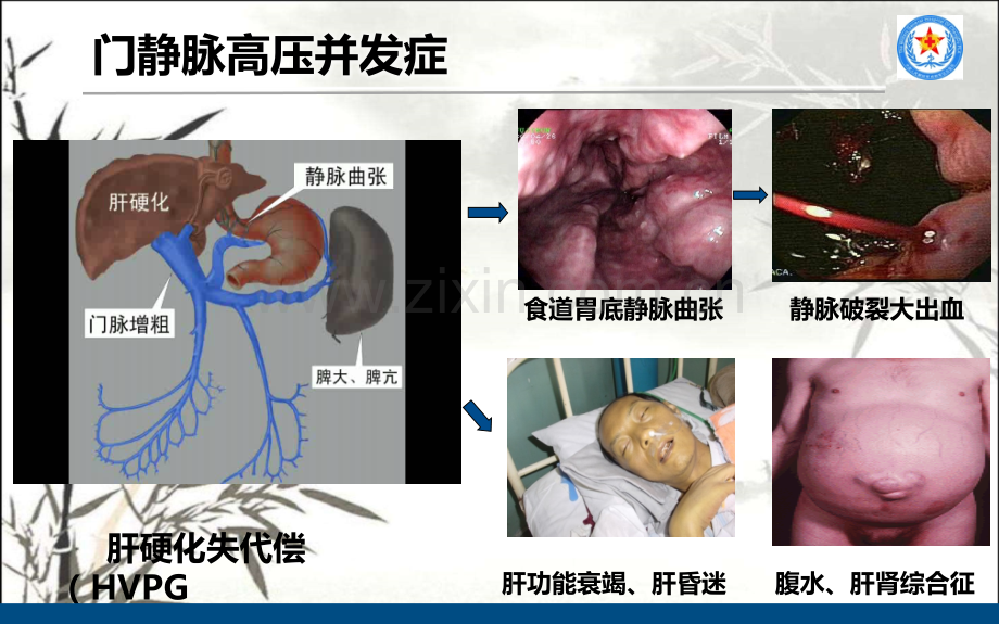 TIPS治疗肝硬化门脉高压ppt.ppt_第2页