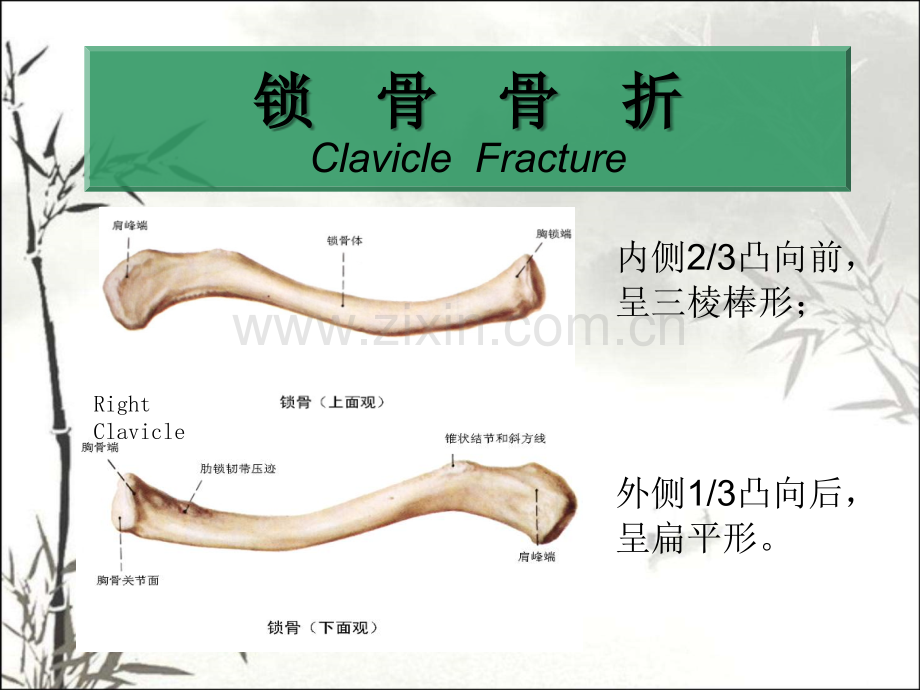 锁骨骨折幻灯片ppt课件.ppt_第1页