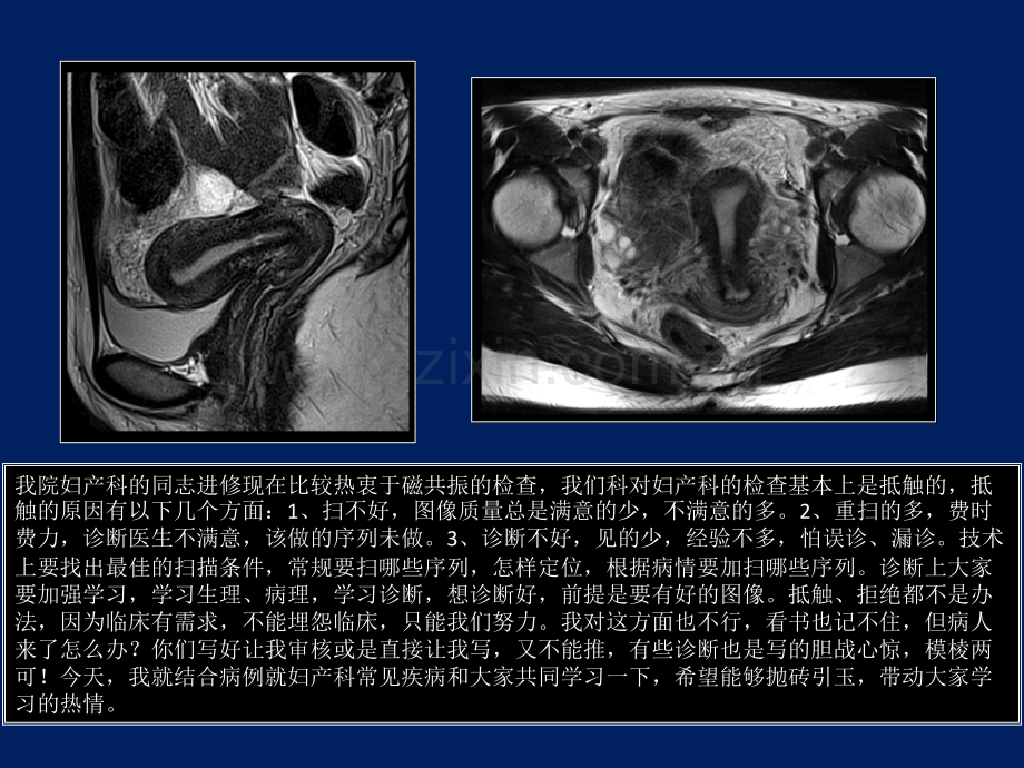 子宫MRI诊断课件-.ppt_第2页