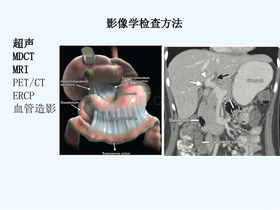 肝门部病变影像学表现ppt.pptx_第2页