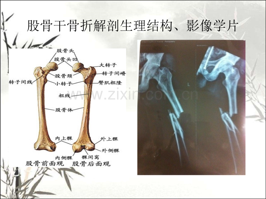 股骨骨折护理查房ppt.ppt_第3页