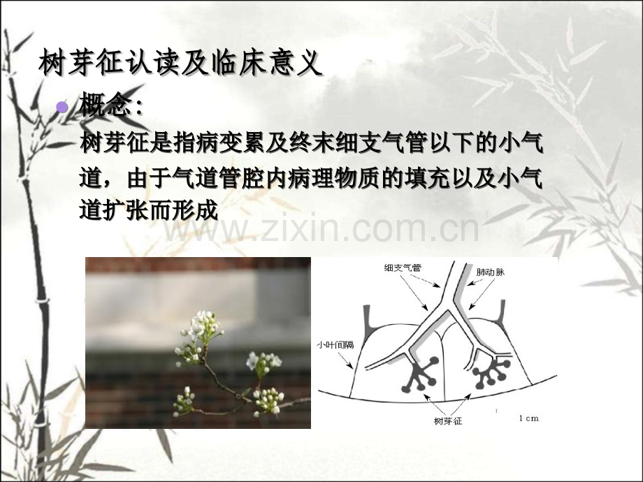 树芽征认读及临床意义PPT.ppt_第2页