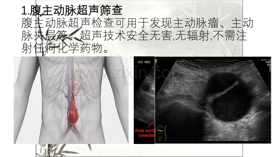 血管超声检查ppt.ppt_第2页