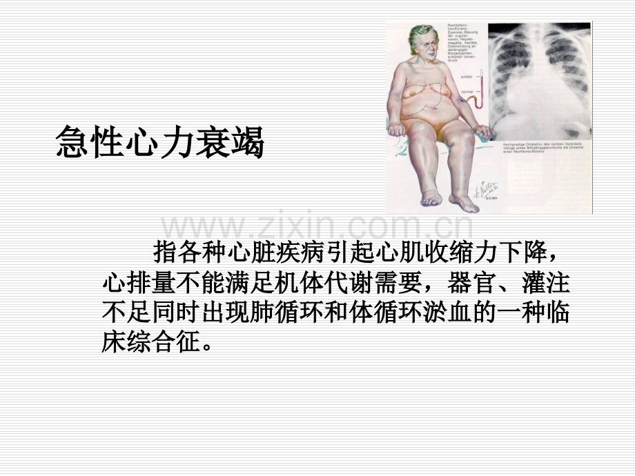 急性心力衰竭的急救护理ppt.ppt_第3页