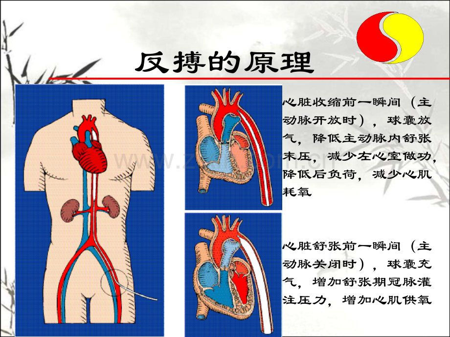 IABP原理及使用ppt课件.ppt_第2页