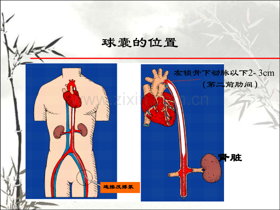 IABP原理及使用ppt课件.ppt_第3页