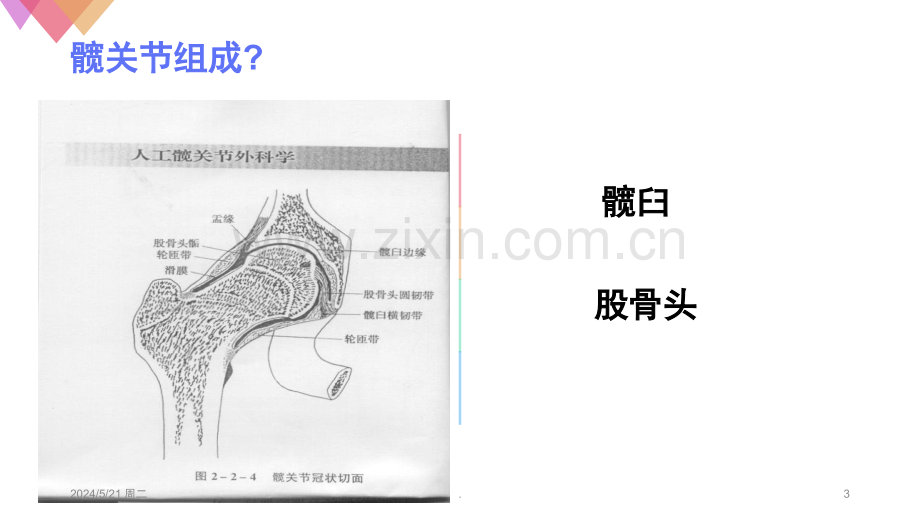 股骨颈骨折病人.ppt_第3页