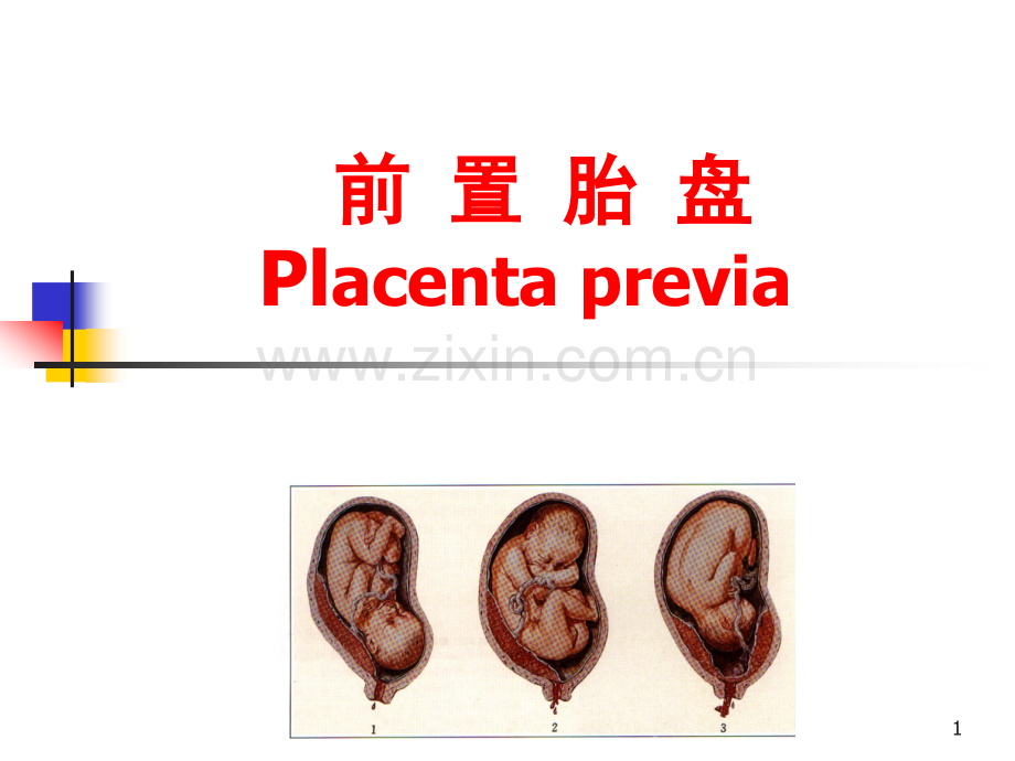 21前置胎盘医学PPT课件.ppt_第1页