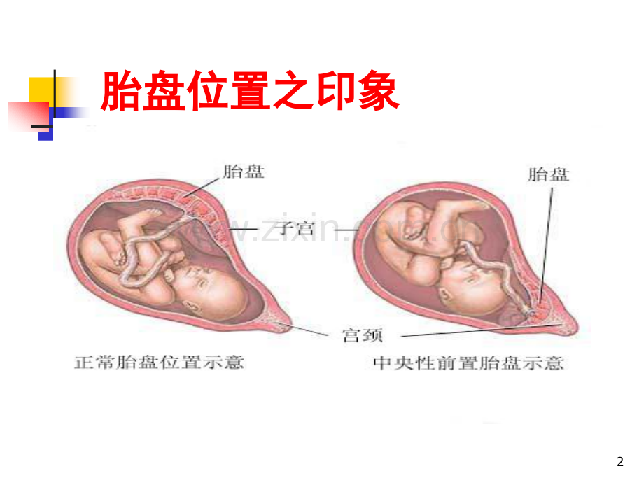 21前置胎盘医学PPT课件.ppt_第2页