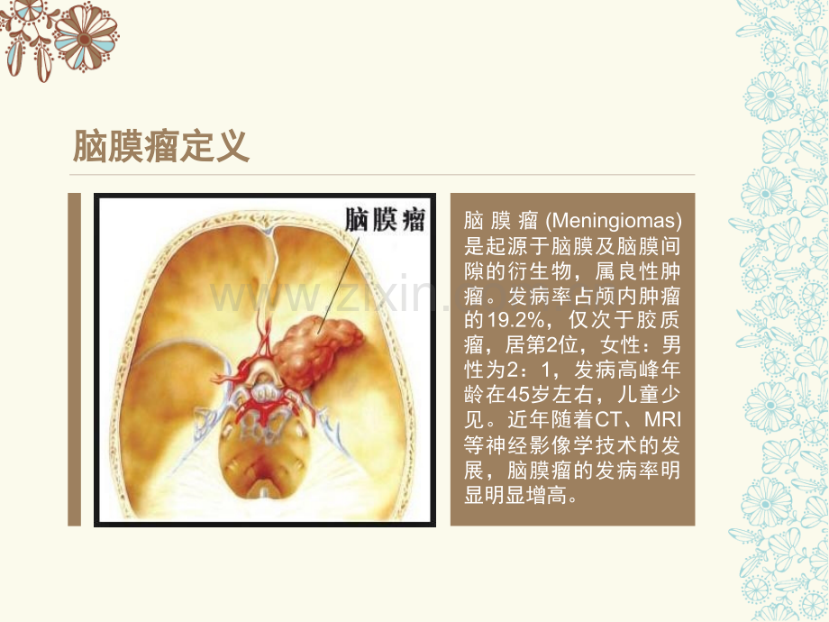 岩斜区脑膜瘤护理查房.ppt_第3页