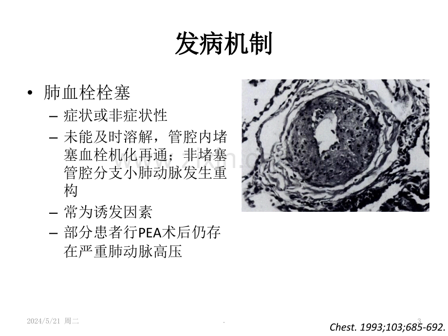 CTEPH诊断治疗进展.ppt_第3页