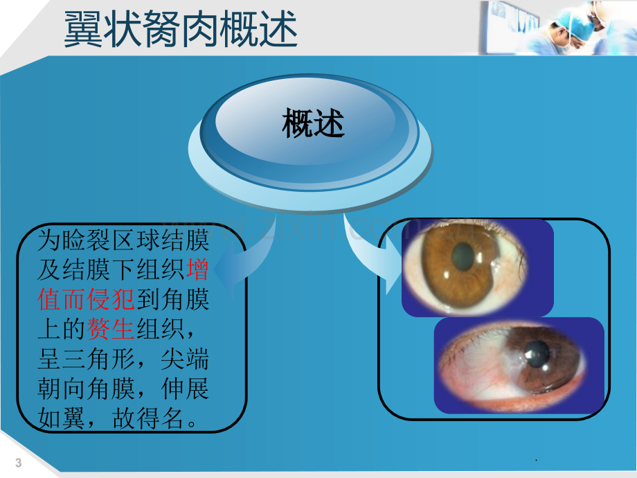 眼科翼状胬肉.ppt_第3页