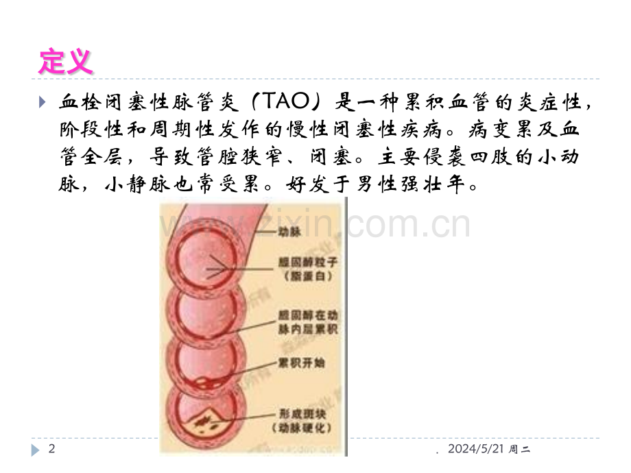 血栓闭塞性脉管炎护理.ppt_第2页