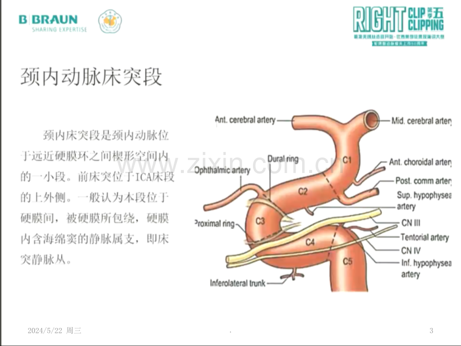 前床突巨大动脉瘤手术夹闭.ppt_第3页