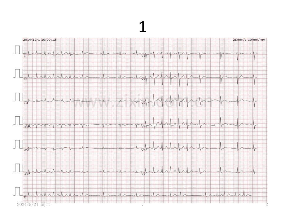 规培心电图测试图例.ppt_第2页