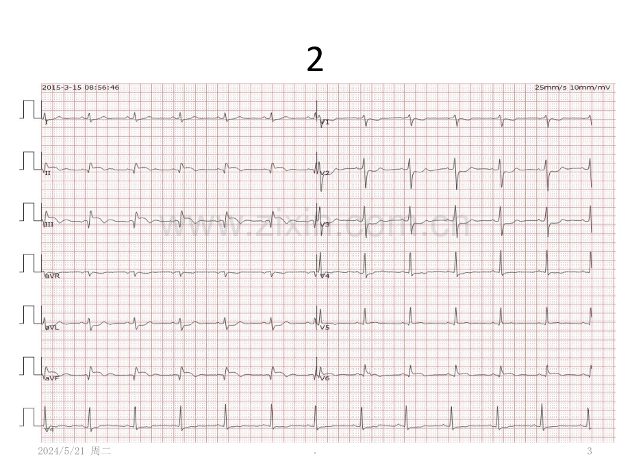 规培心电图测试图例.ppt_第3页