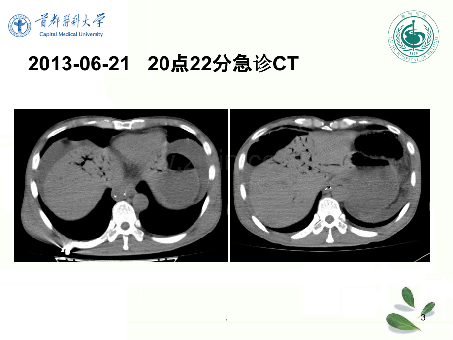 病例讨论-急性坏死性肠炎.ppt_第3页