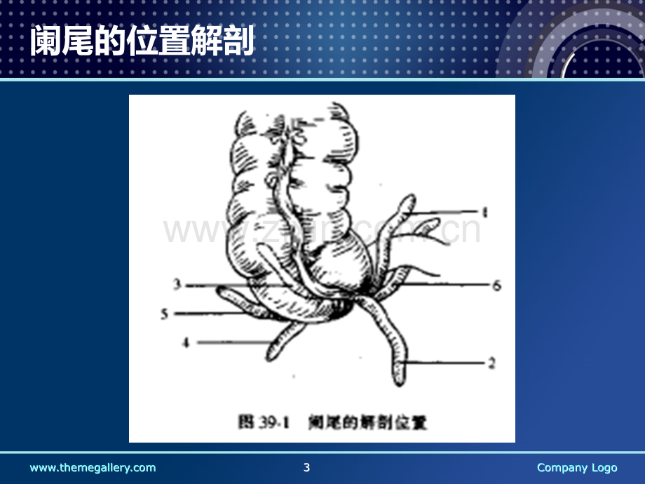 阑尾炎诊断治疗手术.ppt_第3页