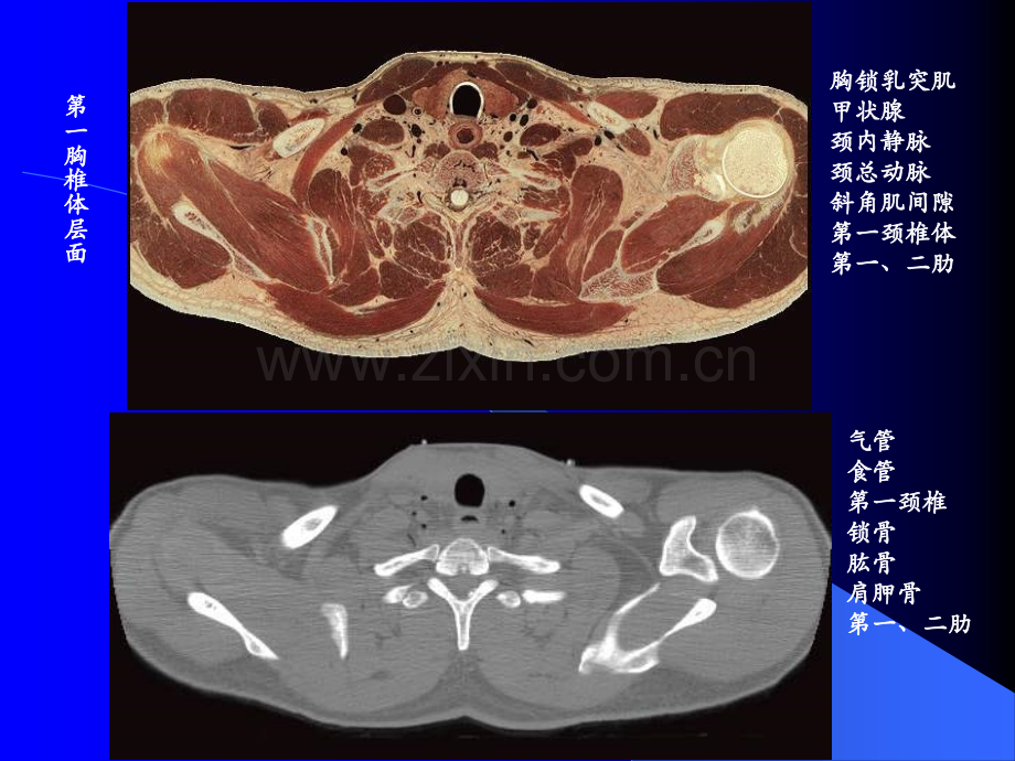 【基础医学】胸横断.ppt_第2页