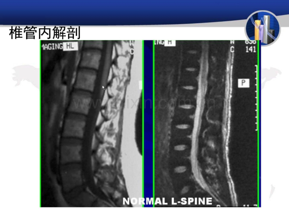 [指南]脊髓和椎管内病变.ppt_第3页