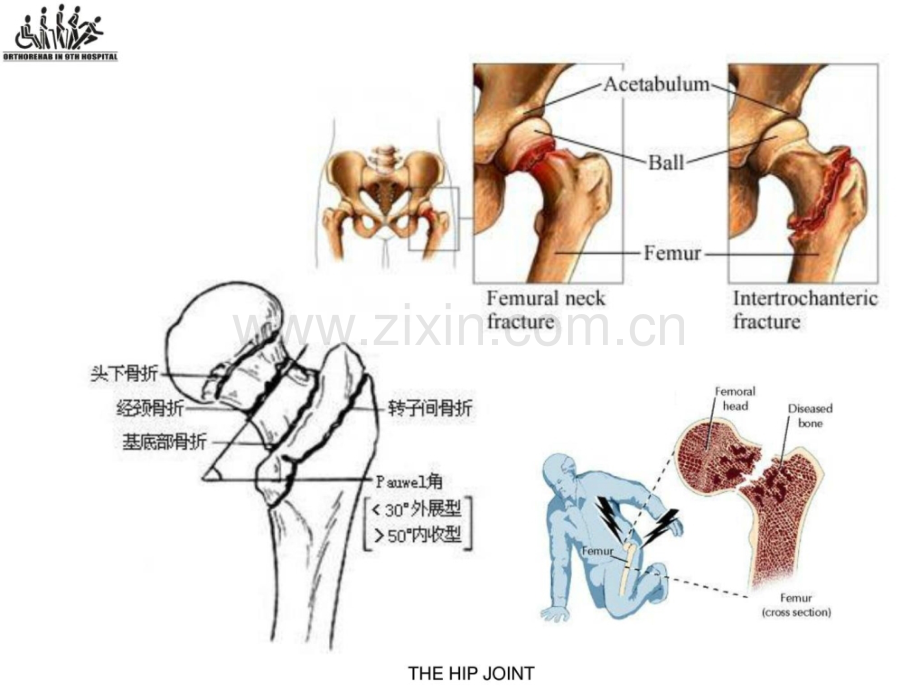 股骨颈骨折围手术期康复.ppt_第3页