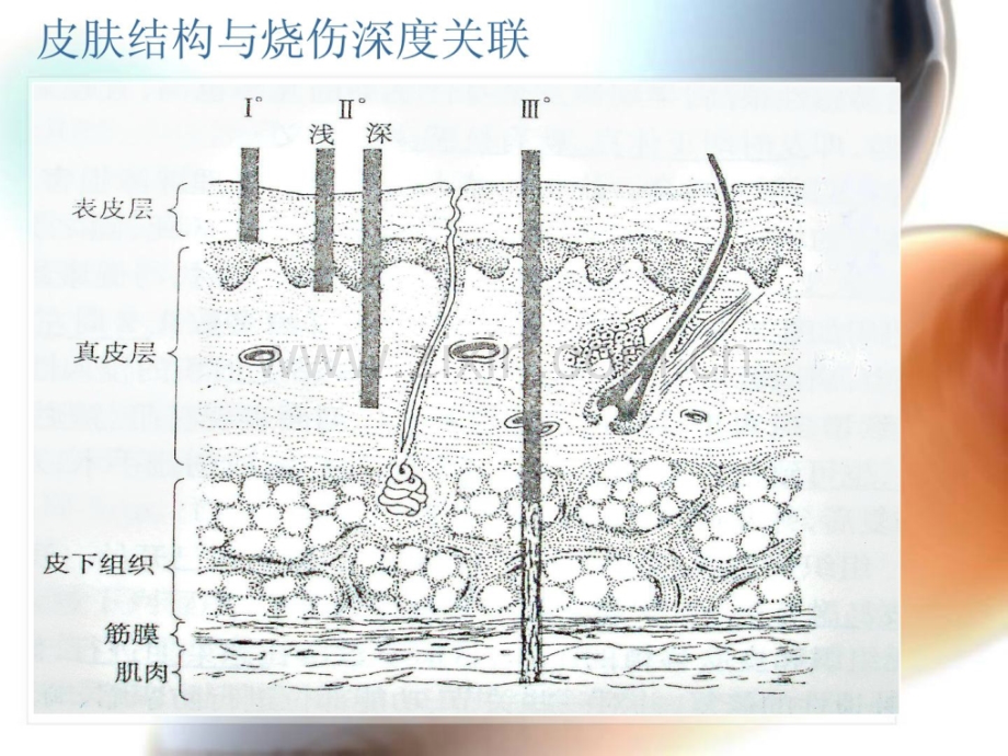 烧伤深识别.ppt_第2页