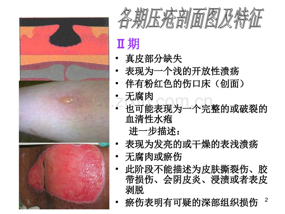 压疮分期图片及文字说明.ppt_第2页